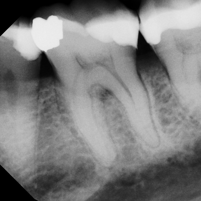 Before Endodontic Treatment Case 4 - Harp Endodontics Manhattan New York